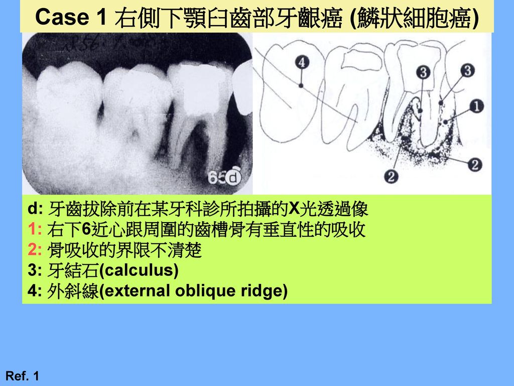 部牙龈癌(鳞状细胞癌 d 牙齿拔除前在某牙科诊所拍摄的x光透过像 1